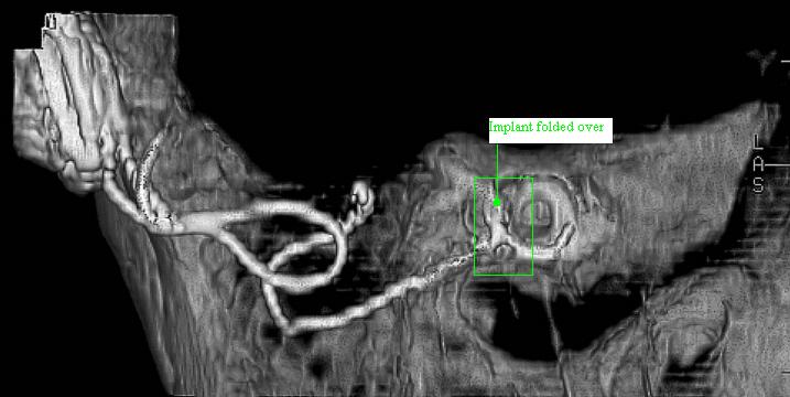 Figure 1 – “Folded over” implant demonstrated by 3-D CT
